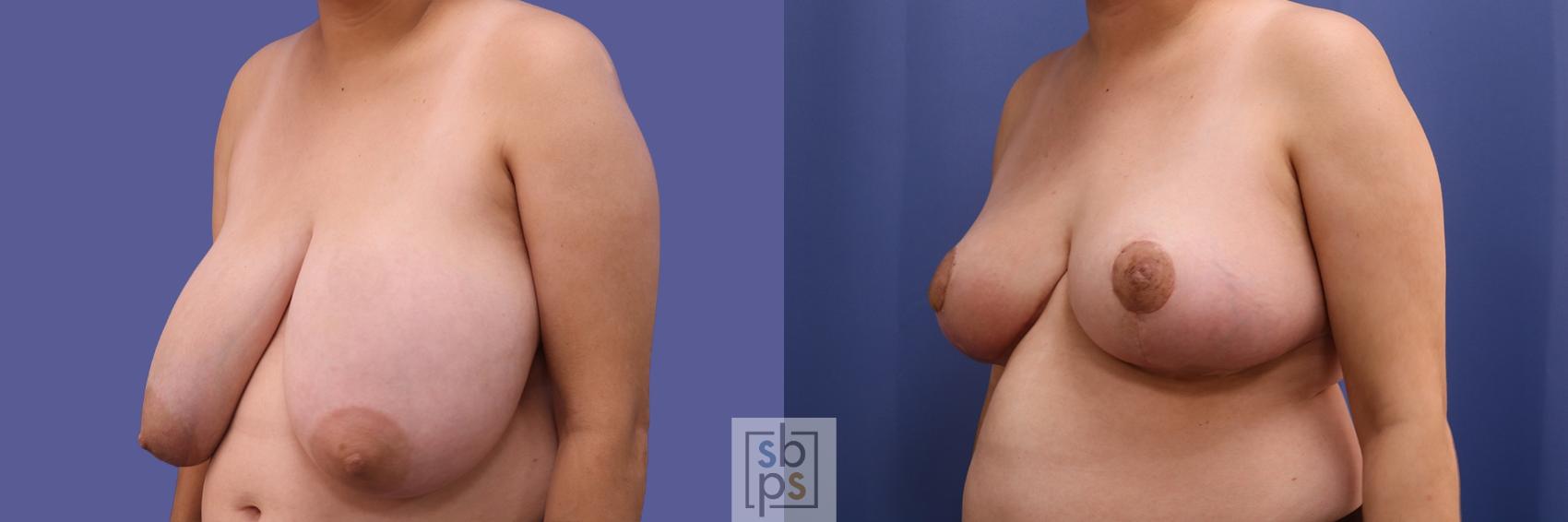 Before & After Breast Reduction Case 417 Left Oblique View in Torrance & Los Angeles, CA, CA