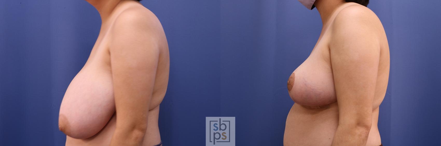 Before & After Breast Reduction Case 417 Left Side View in Torrance & Los Angeles, CA, CA