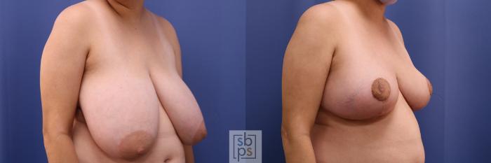 Before & After Breast Reduction Case 417 Right Oblique View in Torrance, CA