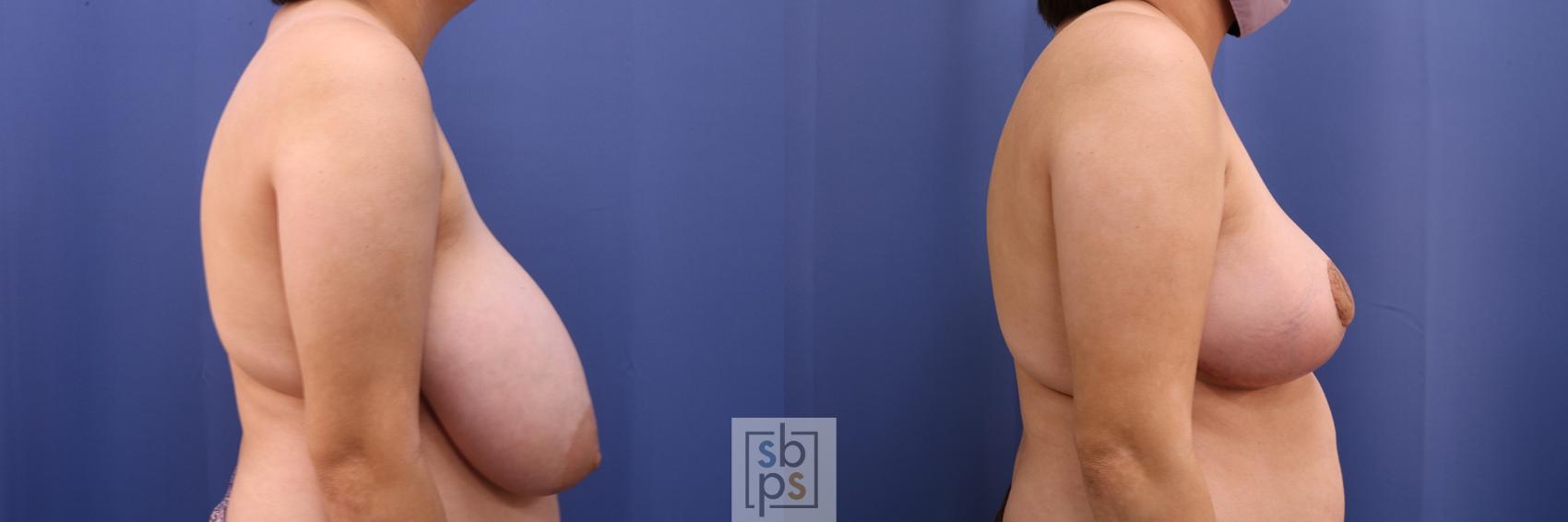 Before & After Breast Reduction Case 417 Right Side View in Torrance & Los Angeles, CA, CA