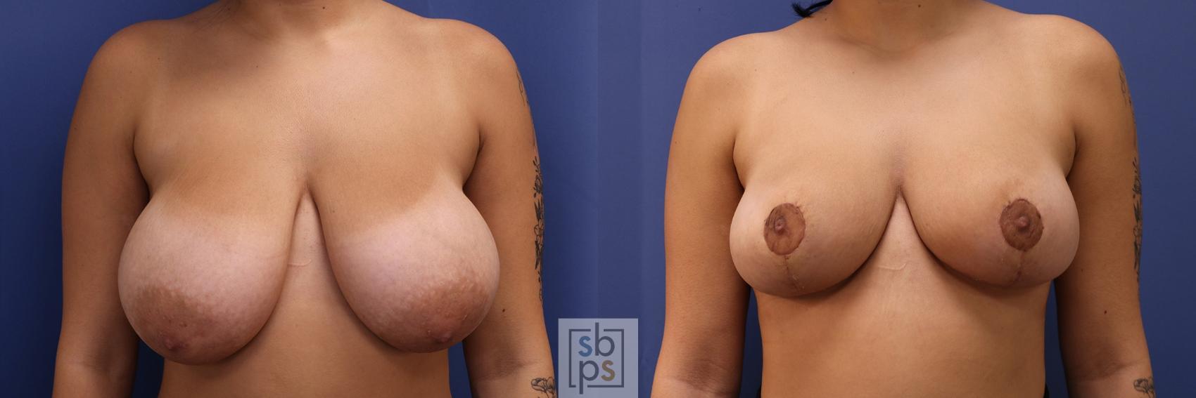 Before & After Breast Reduction Case 423 Front View in Torrance, CA
