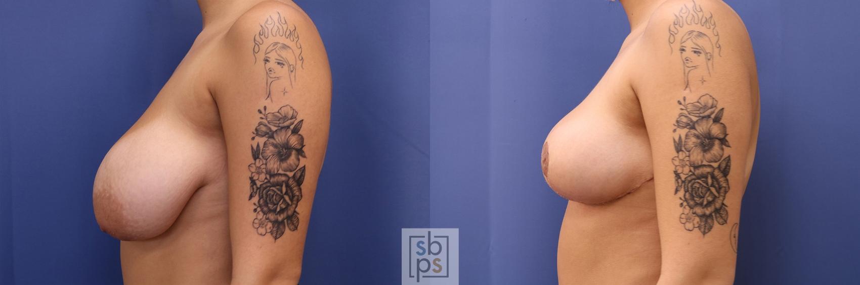 Before & After Breast Reduction Case 423 Left Side View in Torrance & Los Angeles, CA, CA