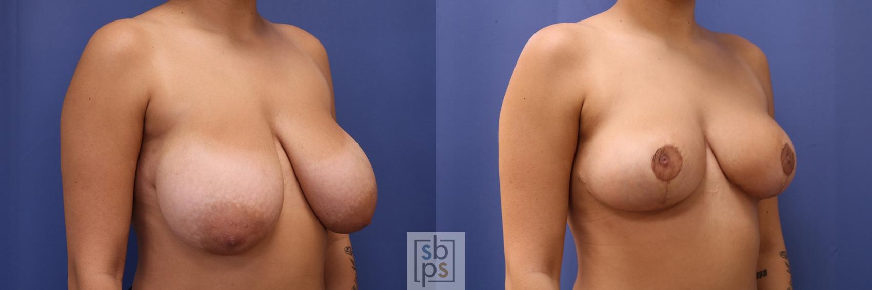 Before & After Breast Reduction Case 423 Right Oblique View in Torrance & Los Angeles, CA, CA