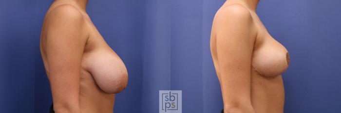 Before & After Breast Reduction Case 423 Right Side View in Torrance, CA