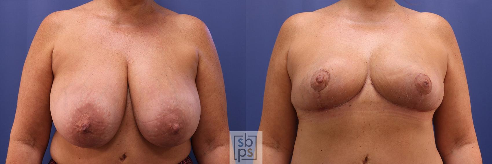 Before & After Breast Reduction Case 424 Front View in Torrance, CA