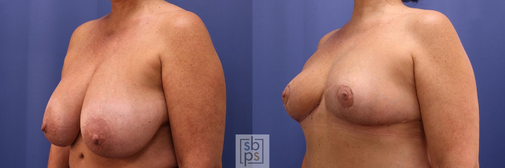 Before & After Breast Reduction Case 424 Left Oblique View in Torrance & Los Angeles, CA, CA