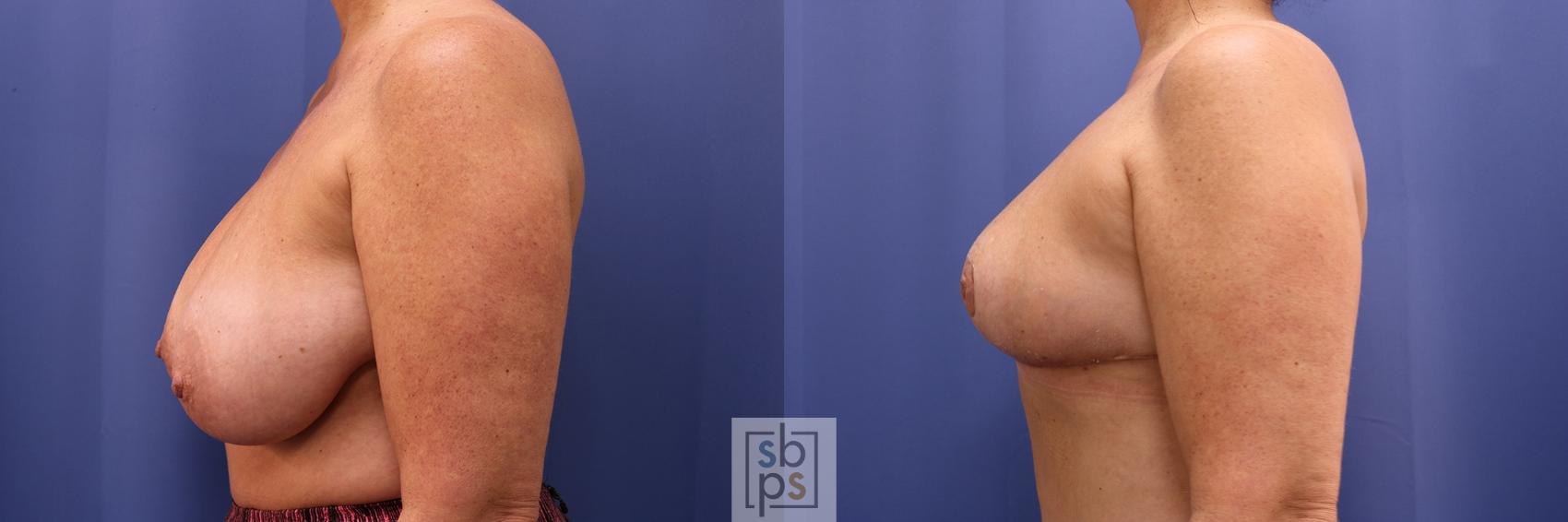Before & After Breast Reduction Case 424 Left Side View in Torrance & Los Angeles, CA, CA