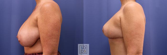 Before & After Breast Reduction Case 424 Left Side View in Torrance, CA