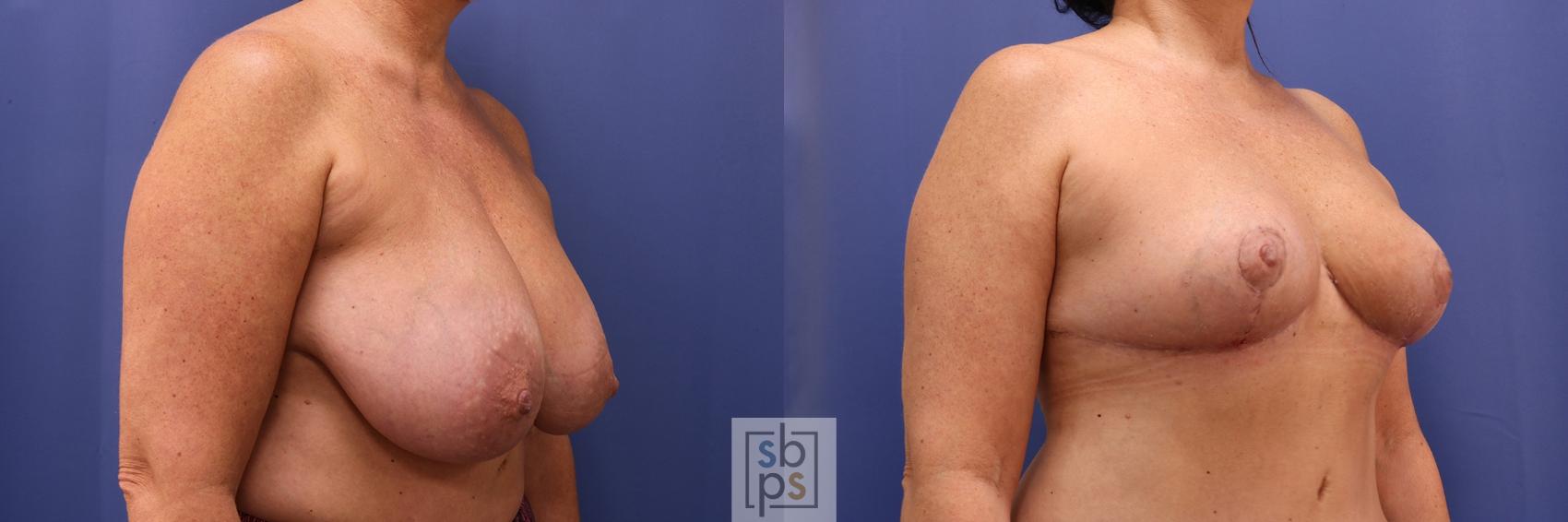 Before & After Breast Reduction Case 424 Right Oblique View in Torrance & Los Angeles, CA, CA