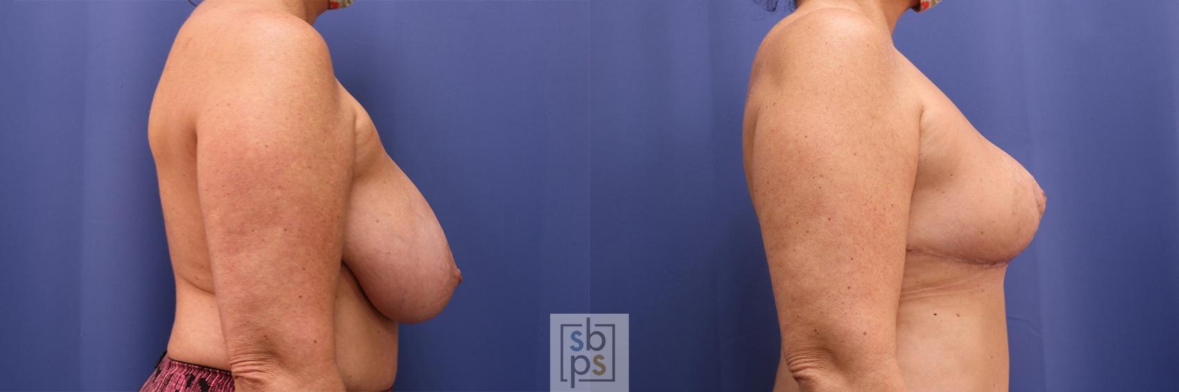 Before & After Breast Reduction Case 424 Right Side View in Torrance & Los Angeles, CA, CA