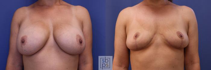 Before & After Breast Reduction Case 434 Front View in Torrance, CA