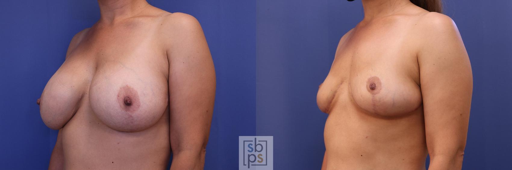 Before & After Breast Reduction Case 434 Left Oblique View in Torrance & Los Angeles, CA, CA