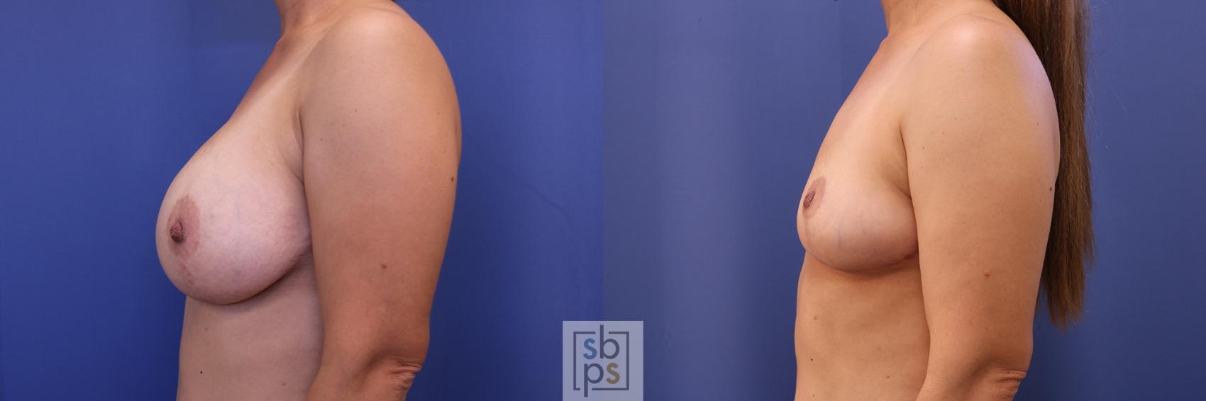 Before & After Breast Reduction Case 434 Left Side View in Torrance & Los Angeles, CA, CA