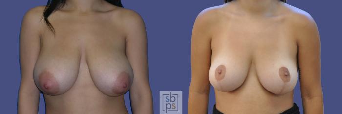 Before & After Breast Reduction Case 444 Front View in Torrance, CA