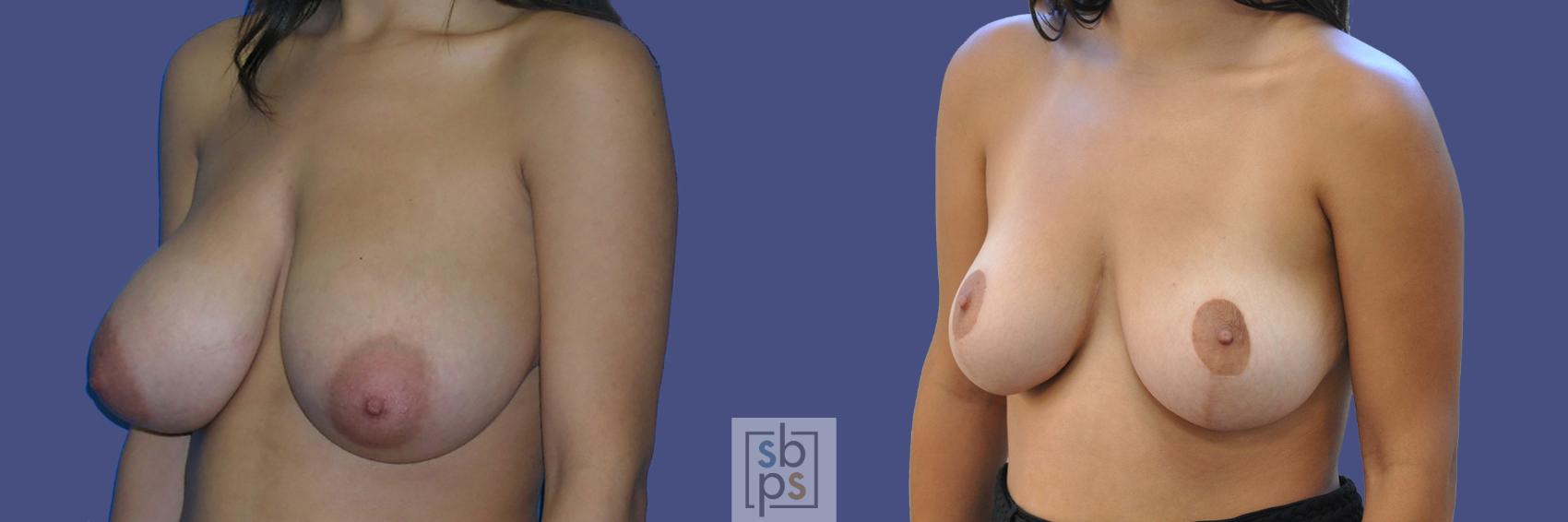 Before & After Breast Reduction Case 444 Left Oblique View in Torrance & Los Angeles, CA, CA