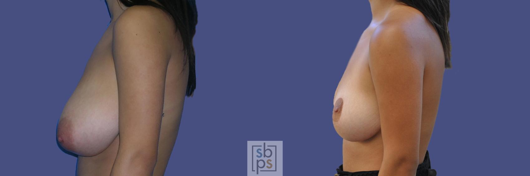 Before & After Breast Reduction Case 444 Left Side View in Torrance & Los Angeles, CA, CA