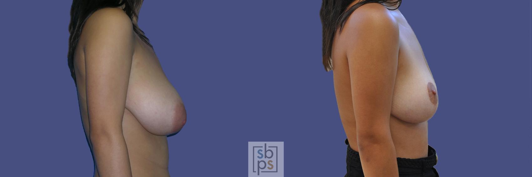 Before & After Breast Reduction Case 444 Right Side View in Torrance & Los Angeles, CA, CA