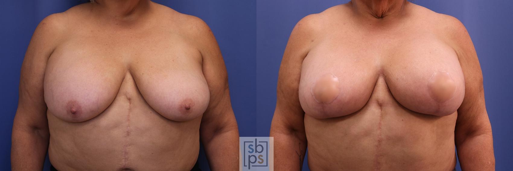 Before & After Breast Reduction Case 447 Front View in Torrance, CA