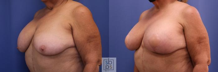 Before & After Breast Reduction Case 447 Left Oblique View in Torrance, CA