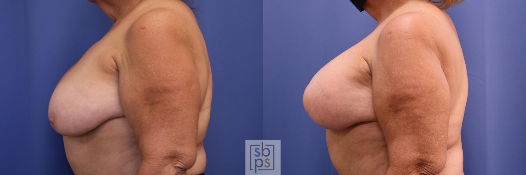 Before & After Breast Reduction Case 447 Left Side View in Torrance & Los Angeles, CA, CA
