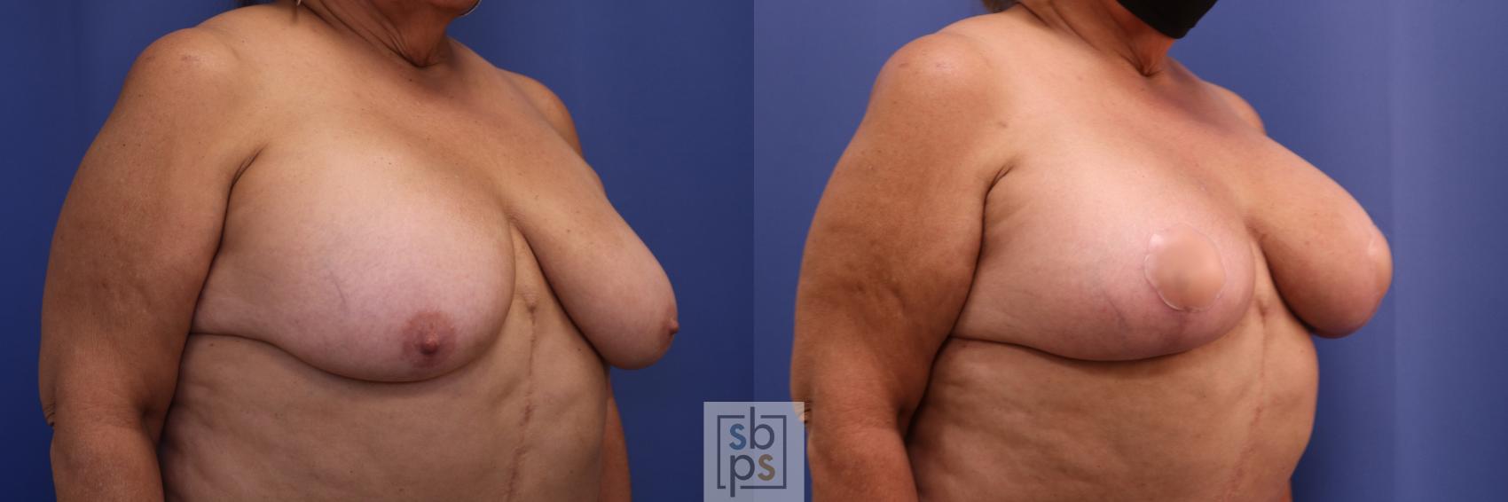 Before & After Breast Reduction Case 447 Right Oblique View in Torrance & Los Angeles, CA, CA