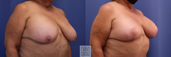 Before & After Breast Reduction Case 447 Right Oblique View in Torrance, CA
