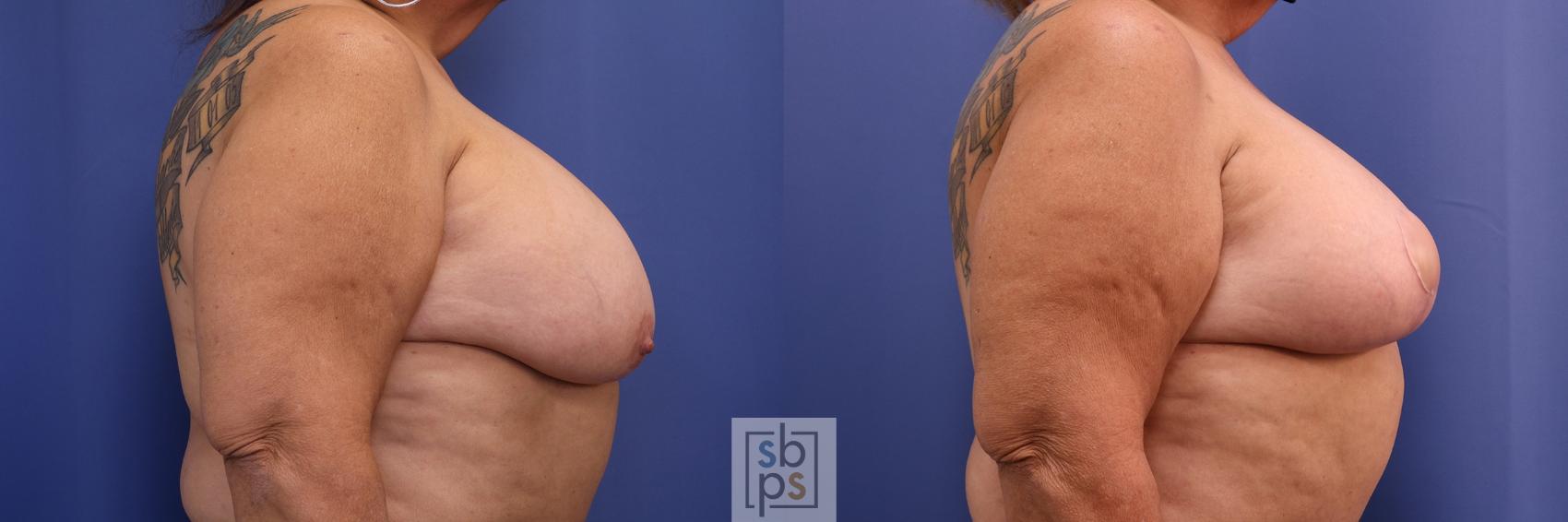 Before & After Breast Reduction Case 447 Right Side View in Torrance & Los Angeles, CA, CA