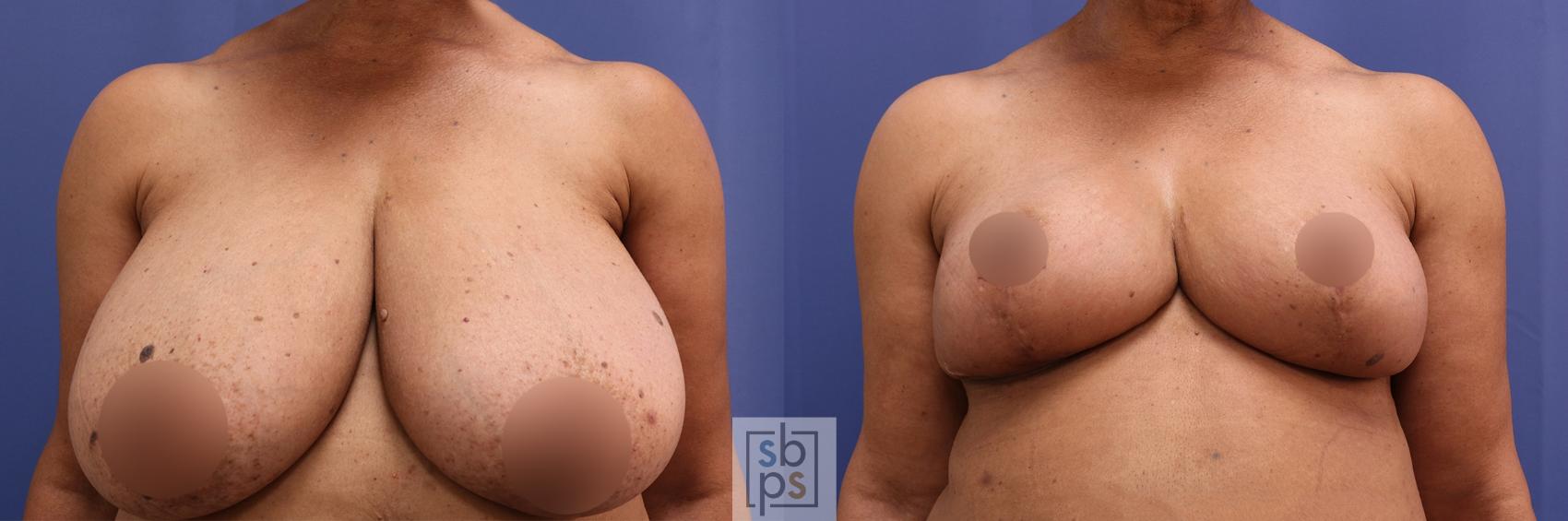 Before & After Breast Reduction Case 456 Front View View in Los Angeles, Torrance & Long Beach, CA