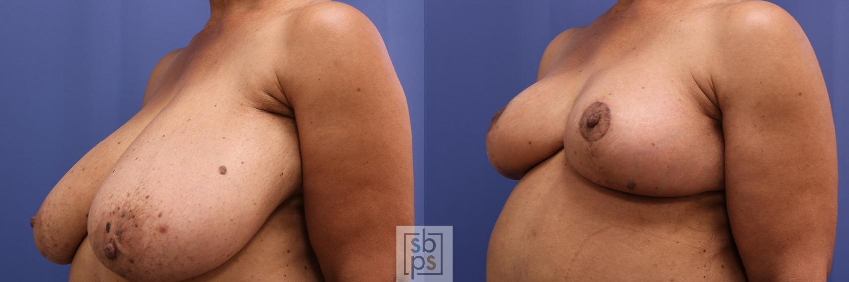 Before & After Breast Reduction Case 456 Left Oblique View in Los Angeles, Torrance & Long Beach, CA