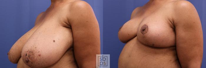 Before & After Breast Reduction Case 456 Left Oblique View in Torrance, CA