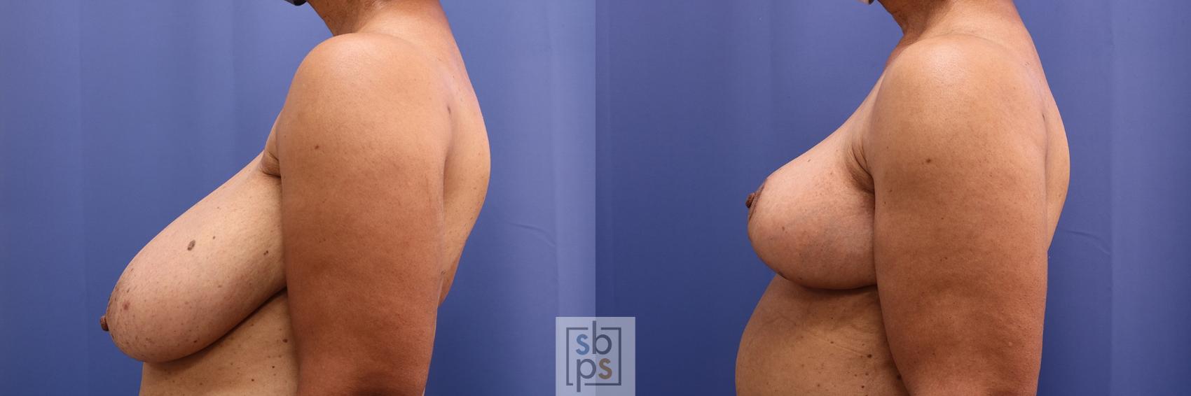 Before & After Breast Reduction Case 456 Left Side View in Los Angeles, Torrance & Long Beach, CA
