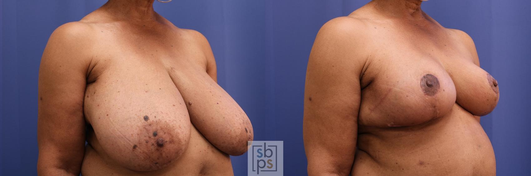 Before & After Breast Reduction Case 456 Right Oblique View in Los Angeles, Torrance & Long Beach, CA