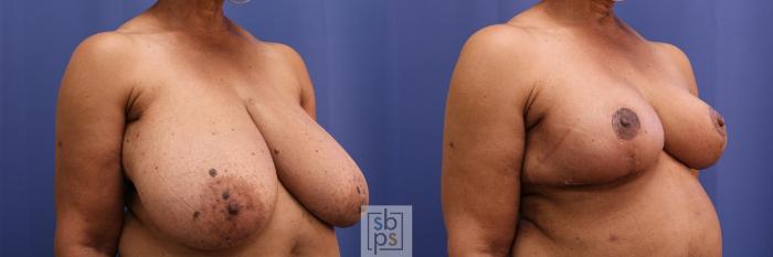 Before & After Breast Reduction Case 456 Right Oblique View in Torrance, CA