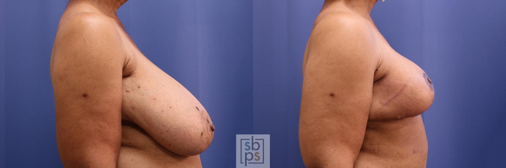 Before & After Breast Reduction Case 456 Right Side View in Los Angeles, Torrance & Long Beach, CA