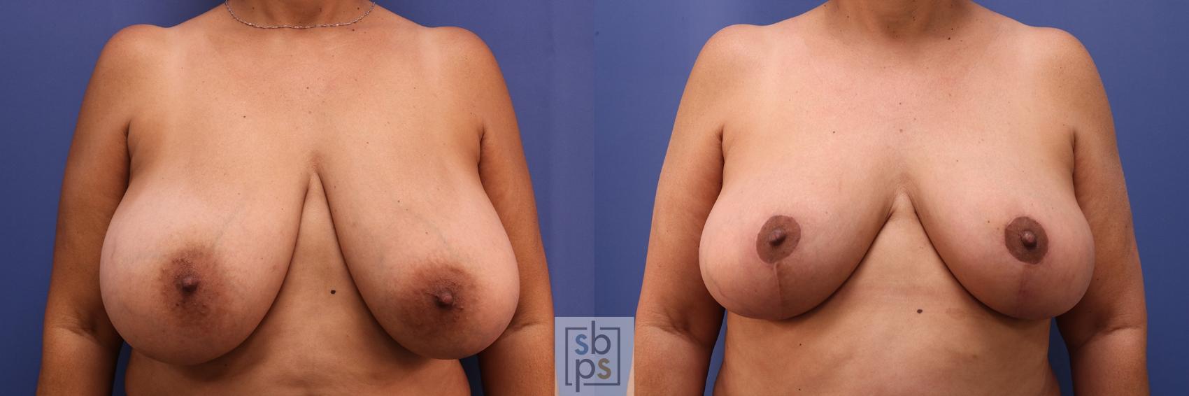 Before & After Breast Reduction Case 459 Front View in Torrance, CA