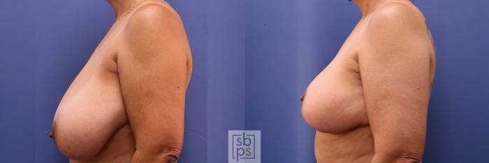 Before & After Breast Reduction Case 459 Left Side View in Torrance, CA