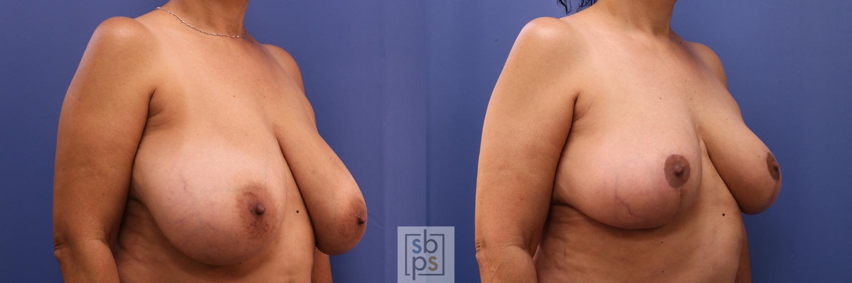 Before & After Breast Reduction Case 459 Right Oblique View in Torrance & Los Angeles, CA, CA