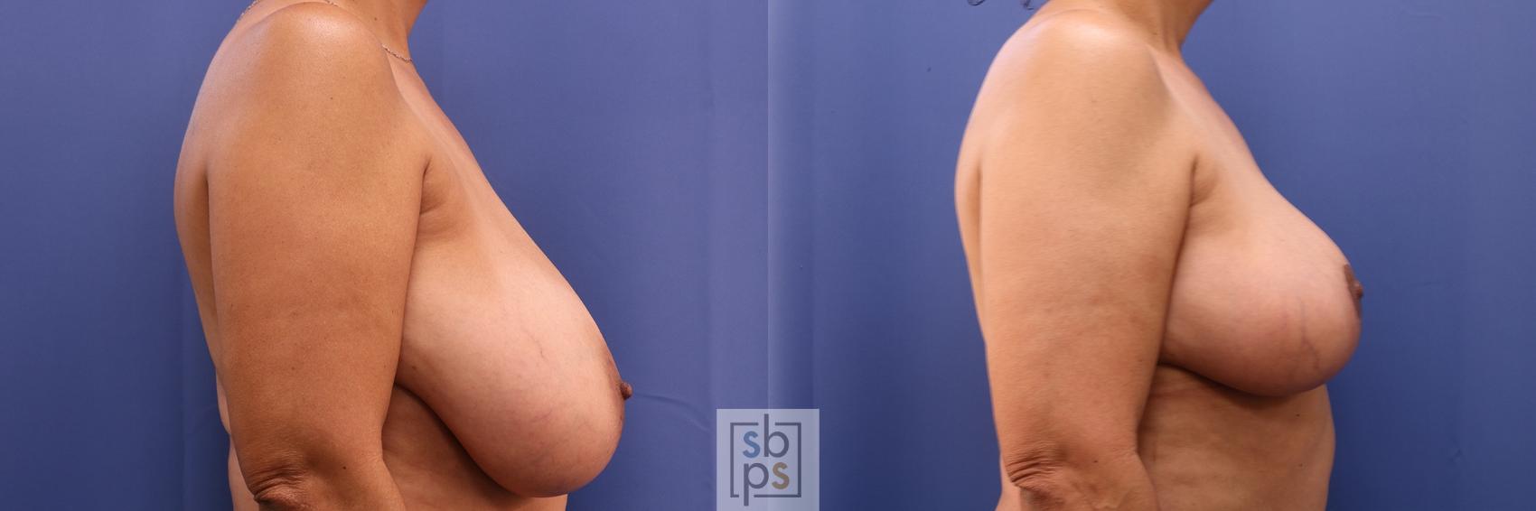 Before & After Breast Reduction Case 459 Right Side View in Torrance & Los Angeles, CA, CA