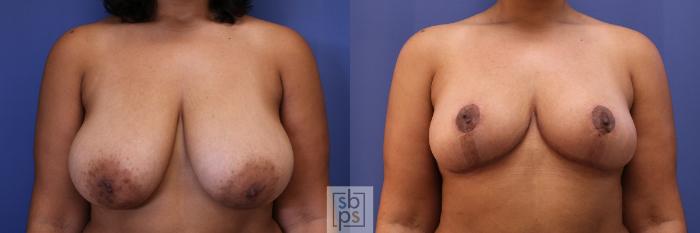 Before & After Breast Reduction Case 462 Front View in Torrance, CA