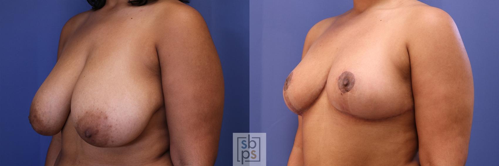 Before & After Breast Reduction Case 462 Left Oblique View in Torrance & Los Angeles, CA, CA