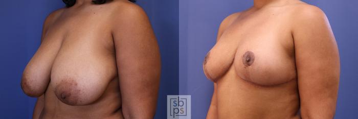 Before & After Breast Reduction Case 462 Left Oblique View in Torrance, CA