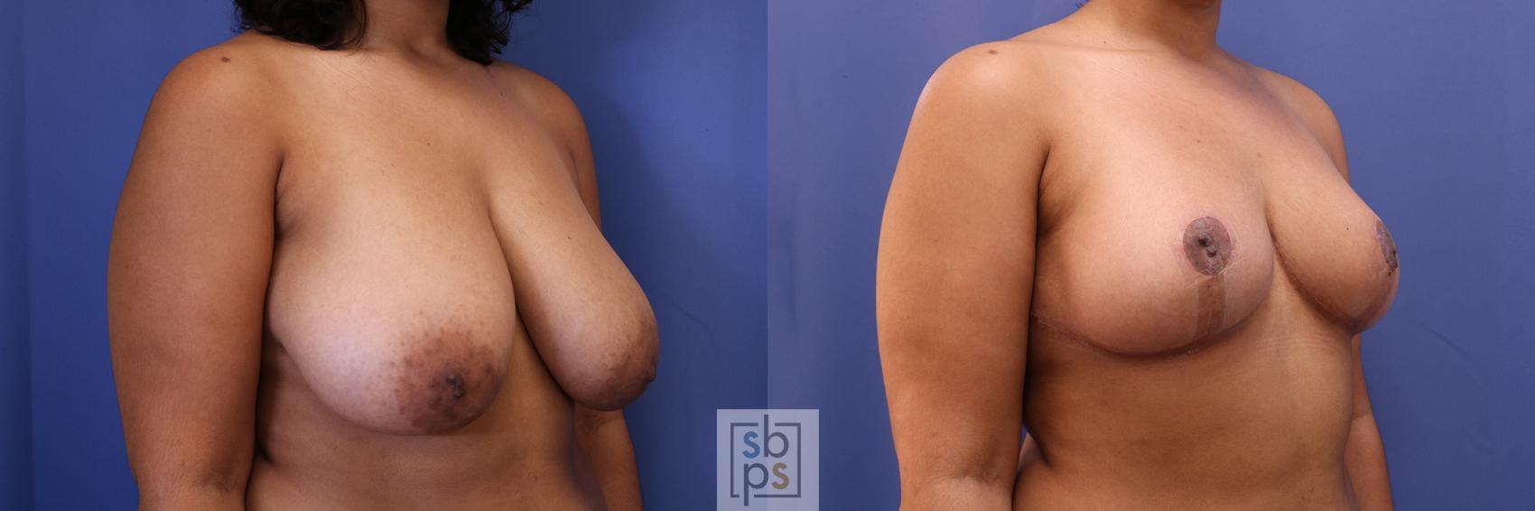 Before & After Breast Reduction Case 462 Right Oblique View in Torrance & Los Angeles, CA, CA
