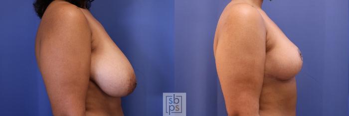 Before & After Breast Reduction Case 462 Right Side View in Torrance, CA
