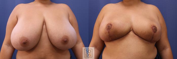 Before & After Breast Reduction Case 463 Front View in Torrance, CA