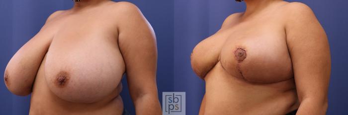 Before & After Breast Reduction Case 463 Left Oblique View in Torrance, CA