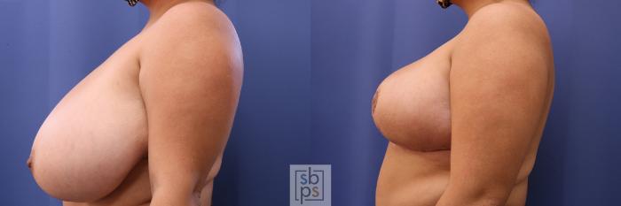 Before & After Breast Reduction Case 463 Left Side View in Torrance, CA