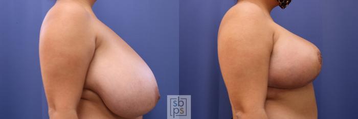 Before & After Breast Reduction Case 463 Right Side View in Torrance, CA