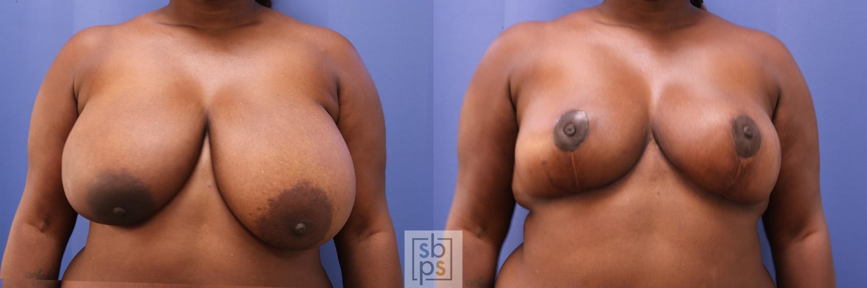 Before & After Breast Reduction Case 464 Front View in Torrance, CA