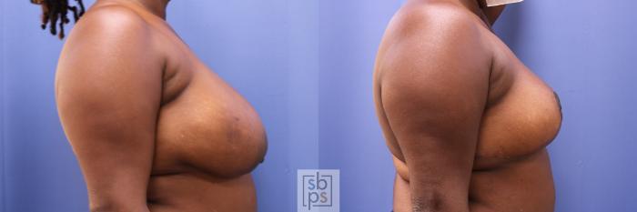 Before & After Breast Reduction Case 464 Right Side View in Torrance, CA