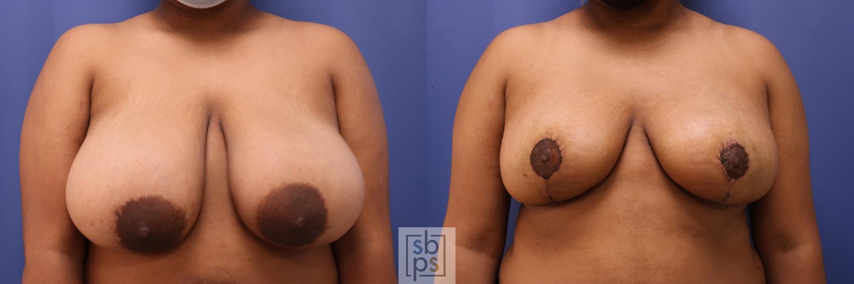 Before & After Breast Reduction Case 467 Front View in Torrance, CA